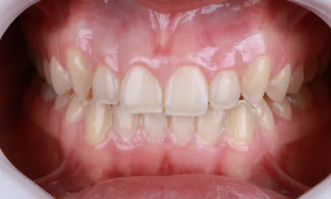 Depois - Mordida Cruzada